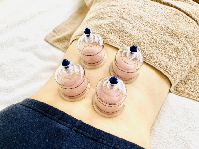 カッピング（吸玉療法）の画像